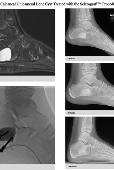 MRI-unicameral-bone-cyst-calcaneus-sclerograft.jpg