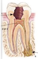 Pathologie de la pulpe