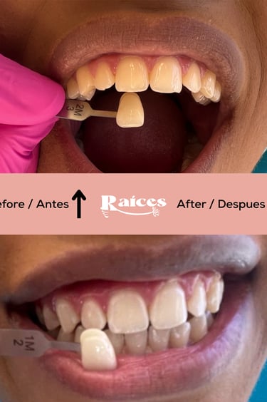 dental teeth whitening tenerife