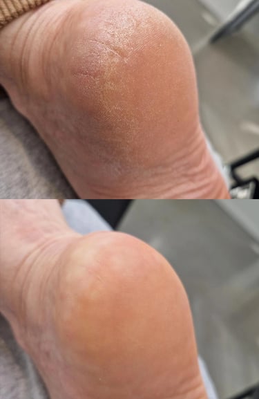 Soin des pieds callosités avant/après