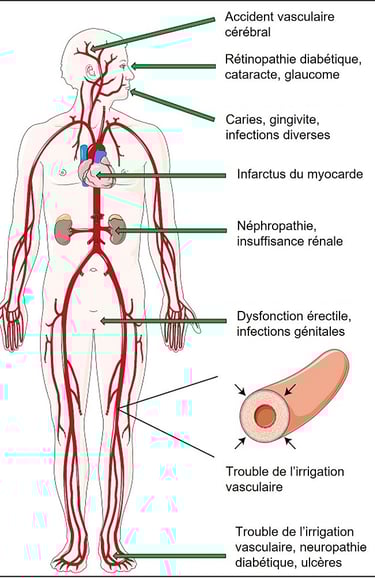complications du diabète