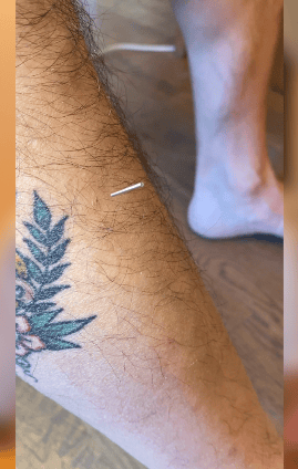 pic shows acu needle in shin muscle, Stomach 36. An american traditional tattoo reads "Heather"