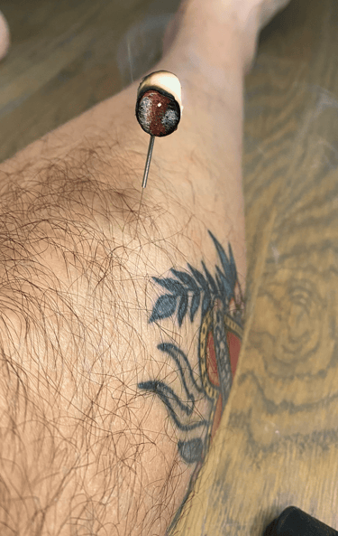 "kyutoshin" or needle moxa burning on top of the needle in Stomach 36. Red embers, white ash & smoke
