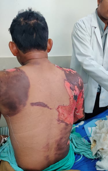 “Expert burn care in Udaipur provided by plastic surgeon Dr Bharat Agarwal”