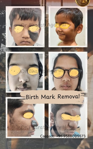 “Hairy black nevus birthmark on skin – evaluation and treatment options explained by Dr Bharat Agarwal”