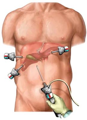 Laparoscopia para realizar colecistectomia
