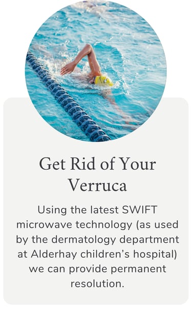 Wart & Verruca Treatment in Melton Mowbray