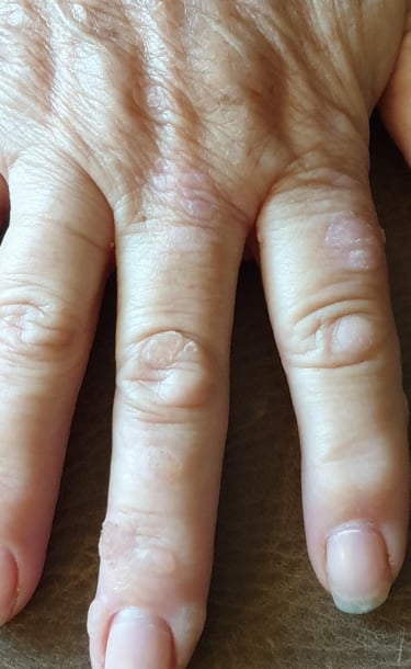 Close-up of common warts on a person's fingers showing rough, raised skin bumps.