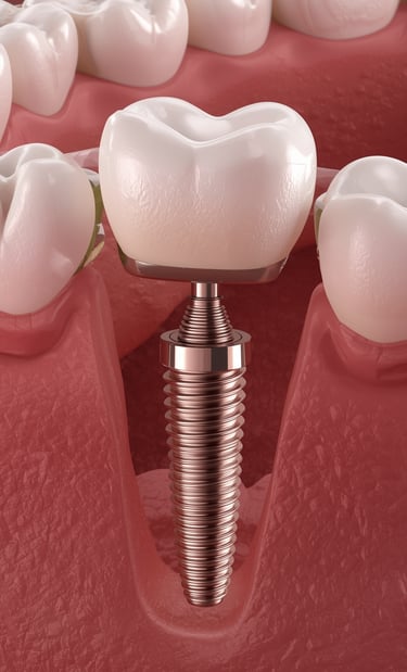 Implante dental de titanio integrado en hueso maxilar con corona dental - Clínica DUPRINS Lima