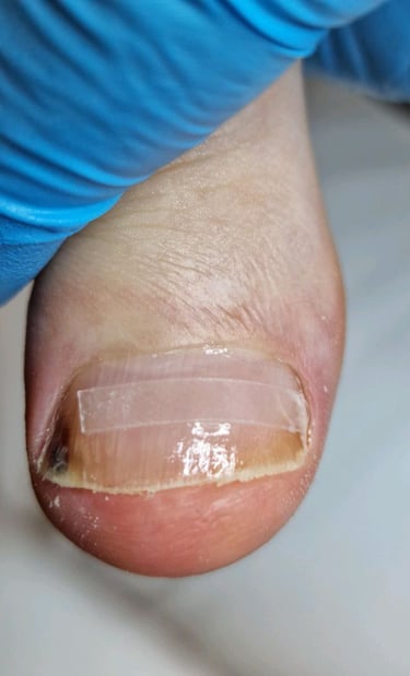 nago korekcija bs plokstele