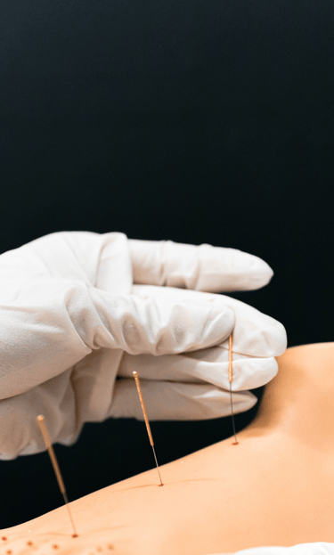 Mobile Dry Needling and Acupuncture in London