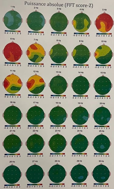 exemple  image cartographie EEG Q