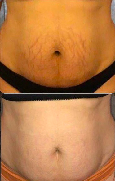 a woman's abdomen before and after a tummying