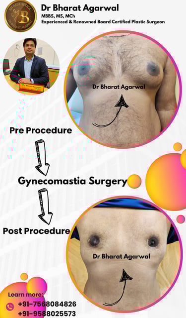 Gynaecomastia surgery, Liposuction, breast surgery, breast reduction, breast augmentation Plastic surgery in udaipur.