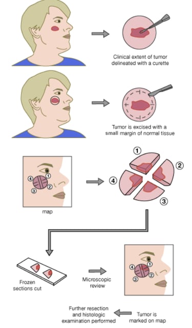 Mohs Surgery Duluth, GA