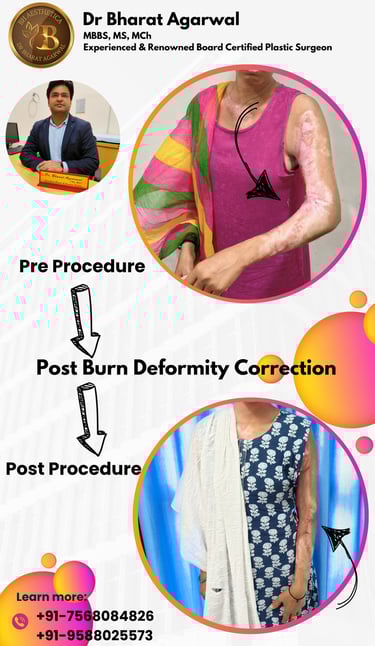 Burn Care & Post Burn Contracture Release Plastic & Reconstructive surgery in Udaipur.