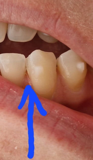 mit invisalign attachments