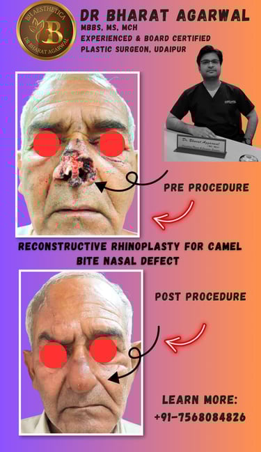 Rhinoplasty and nasal reconstruction surgery in udaipur.