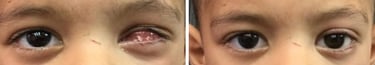 évisceration enucléation prothèse oculaire oculariste nice france avfrance awada