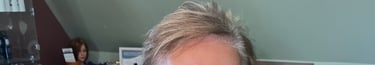 Before permanent non-surgical hair replacement #17 – thinning around the part and sides, hair lying 