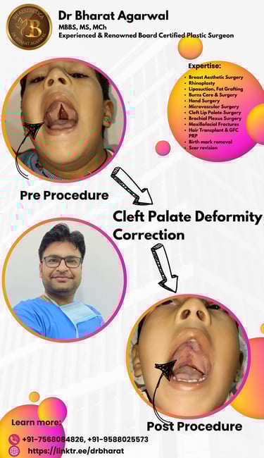 Cleft Lip Cleft Palate Plastic Surgery In Udaipur