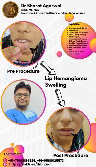 Lip Plastic Surgery in Udaipur.