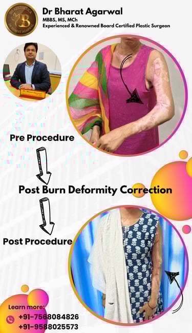 Burn Care & Post Burn Contracture Release Plastic & Reconstructive surgery in Udaipur.