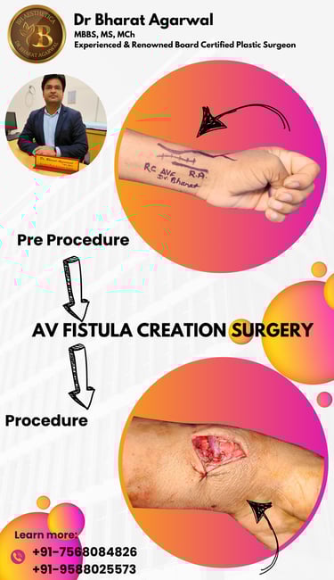 Hand, AV Fistula and Microvascular Surgery in udaipur.