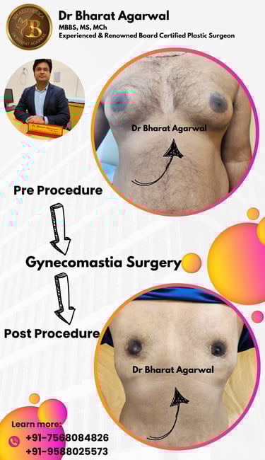 Gynaecomastia surgery, Liposuction, breast surgery, breast reduction, breast augmentation Plastic surgery in udaipur.