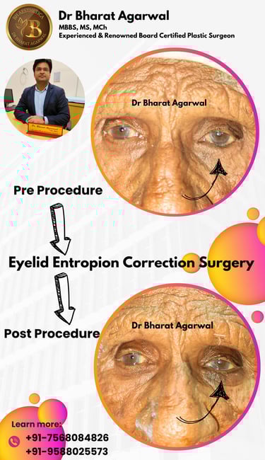 BCC, Basal Cell Carcinoma, face Plastic Surgery in Udaipur.