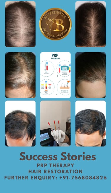 Best Hair transplant surgery FUE Surgery & PRP Therapy & GFC PRP in Udaipur.