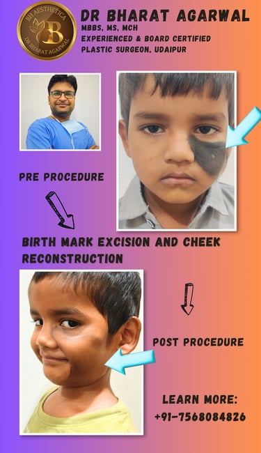Face plastic Surgery in udaipur.