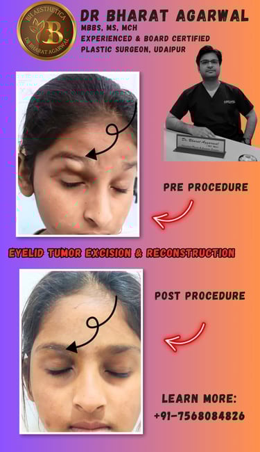 Eyelid Surgery, Blepharoplasty, Ptosis Surgery in Udaipur.