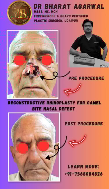 Rhinoplasty and nasal reconstruction surgery in udaipur.