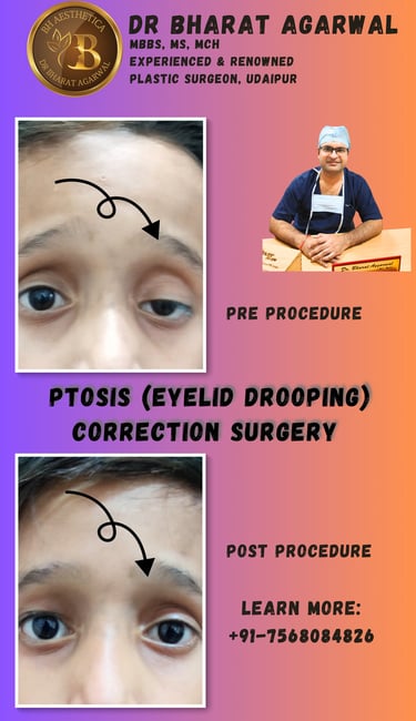 Eyelid Surgery, Blepharoplasty, Ptosis Surgery in Udaipur.