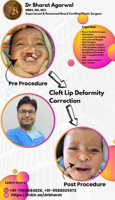 Cleft Lip Plastic Surgery in Udaipur.