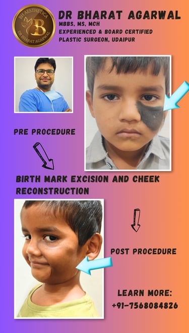 Face plastic Surgery in udaipur.