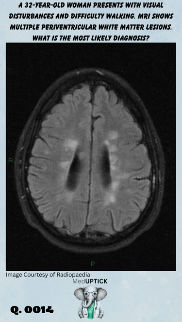 brain CT scan with multiple periventricular white matter lesion