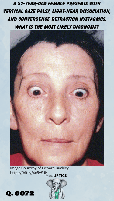 close up of a woman's face who has vertical eye palsy