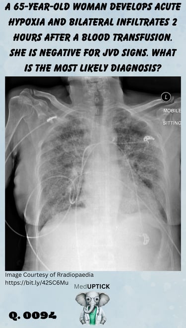 a chest x-ray of a woman with bilateral infiltrates