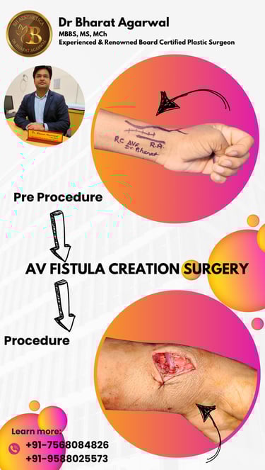 Hand, AV Fistula and Microvascular Surgery in udaipur.