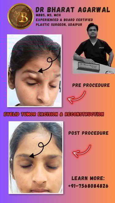 Eyelid Surgery, Blepharoplasty, Ptosis Surgery in Udaipur.
