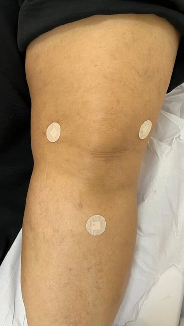 tratamento para artrose do joelho sem cirurgia