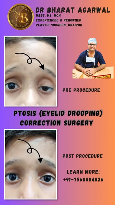 Before-and-after view of ptosis correction procedure to improve eyelid height in Udaipur by Dr Bharat agarwal.