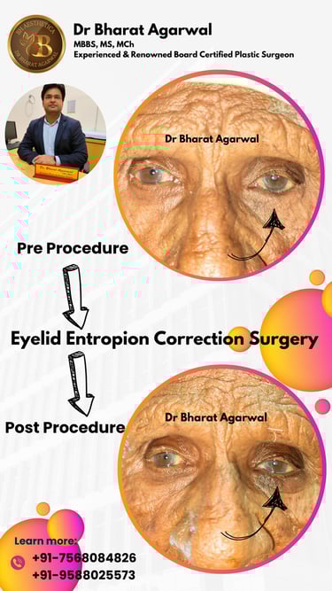BCC, Basal Cell Carcinoma, face Plastic Surgery in Udaipur.