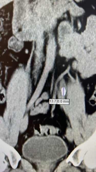 Böbrek taşının tomografi görüntüsü