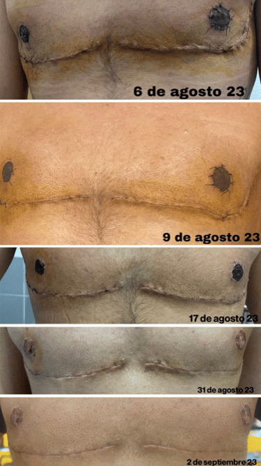 cambio en cicatriz de pecho