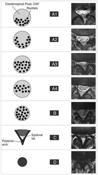 Classifição de Schizas para estenose de canal vertebral em Fortaleza