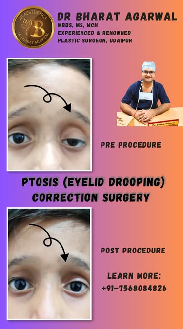 Eyelid Surgery, Blepharoplasty, Ptosis Surgery in Udaipur.