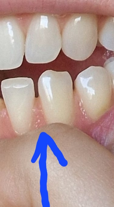 vor invisalign attachments